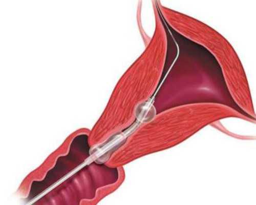 揭秘子宫肌瘤:它如何影响女性的生活质量?